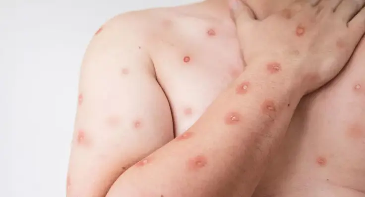 Brasil Reporta 48 Novos Casos de Mpox nos Primeiros Meses de 2026: O Que Isso Significa para a Saúde Pública?