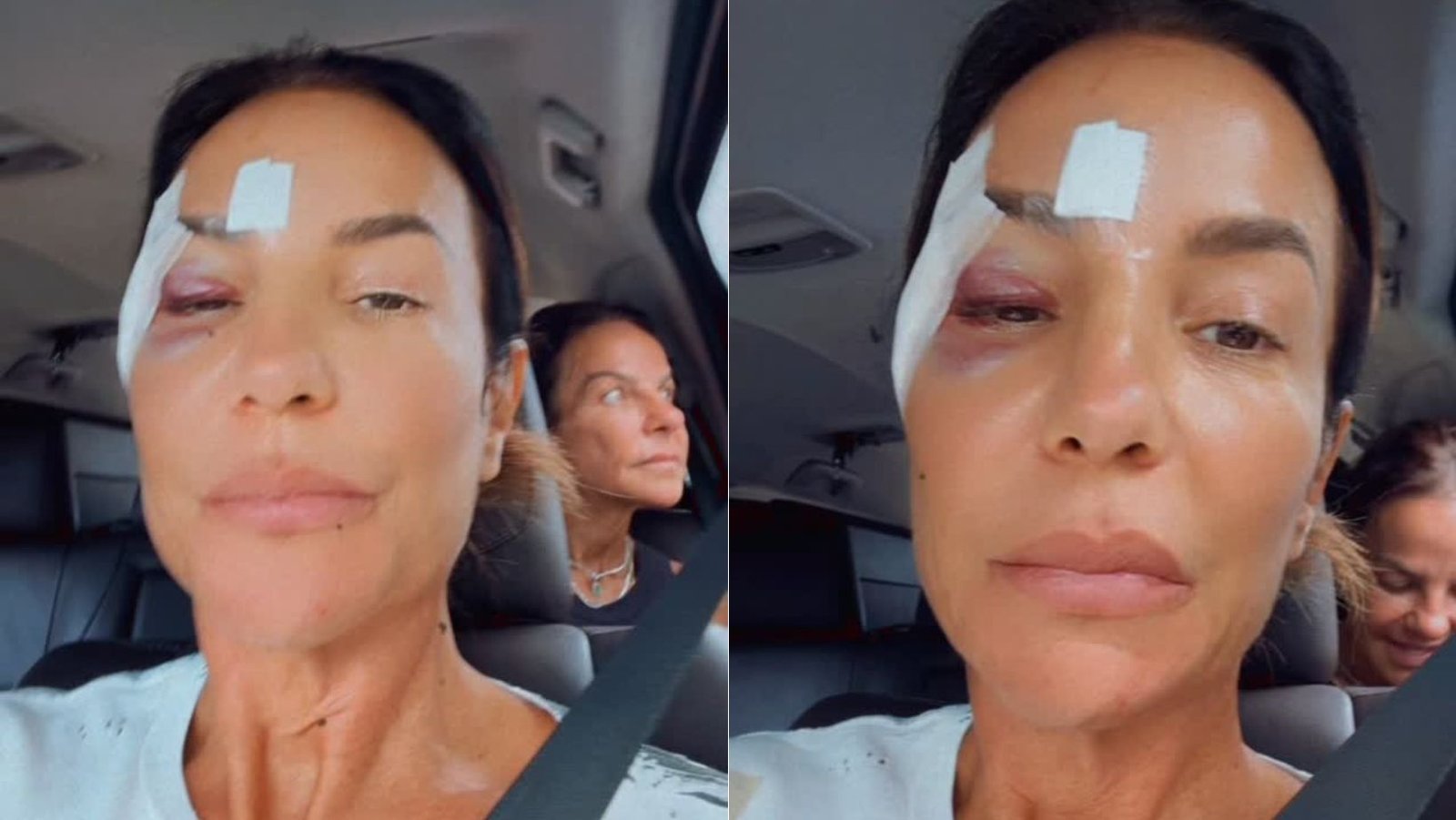 Ivete Sangalo Recebe Alta Após Acidente Doméstico: Cantora Exibe Olho Roxo e Faz Humor com Situação; Assista ao Vídeo