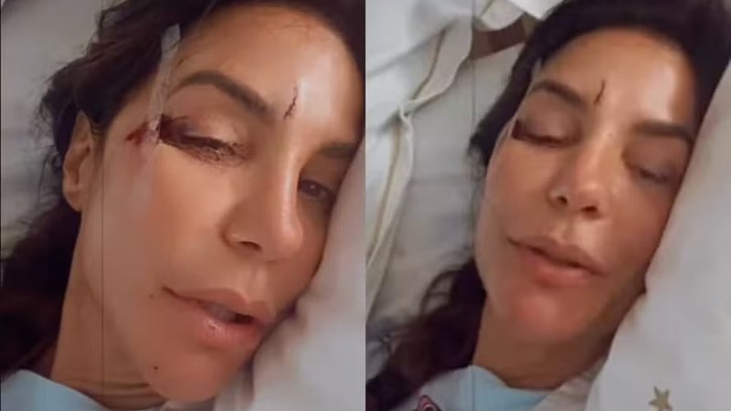 Ivete Sangalo Surpreende ao Aparecer em Hospital com Ferimentos Faciais e Compartilha Experiência de Sustos