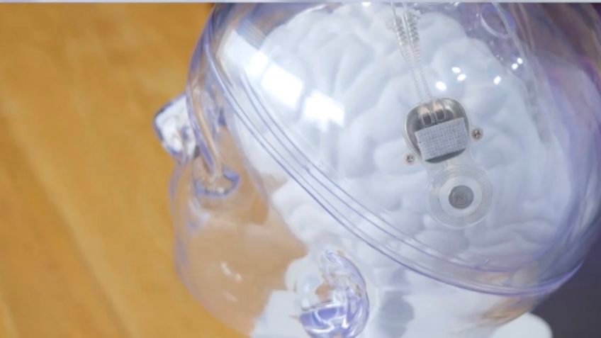 China Autoriza Uso de Implante Cerebral em Tratamento de Tetraplegia: Avanços Inovadores na Medicina