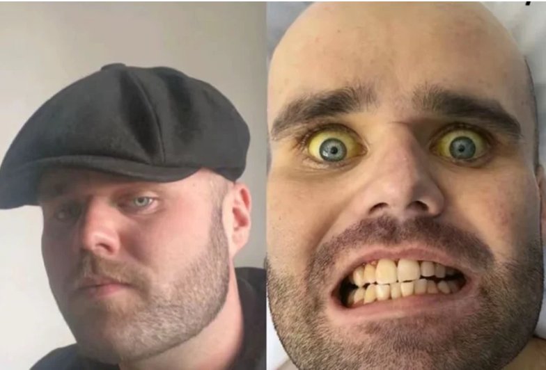 Consumo Excessivo de Vodca: Homem Sofre com Icterícia e Lesões Hepáticas Severas