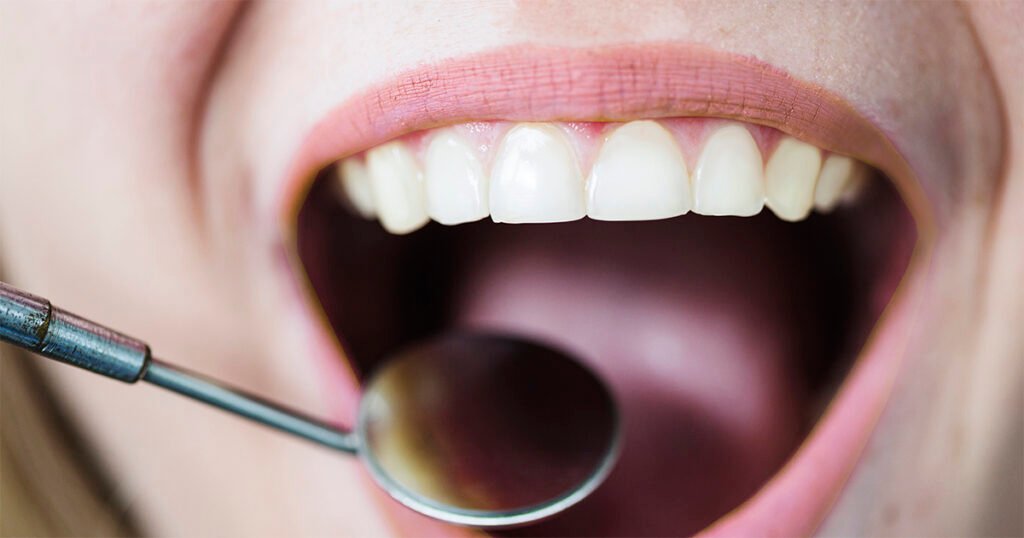 Imagem da boca aberta de uma mulher branca sob exame de um aparelho odontológico