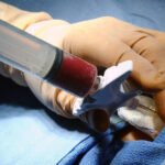 Avanços em transplante de medula óssea com terapias inovadoras no HC