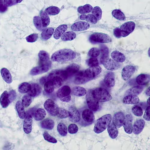 Células cancerígenas: como desenvolvem resistência à quimioterapia