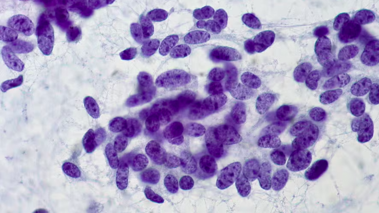 Células cancerígenas: como desenvolvem resistência à quimioterapia