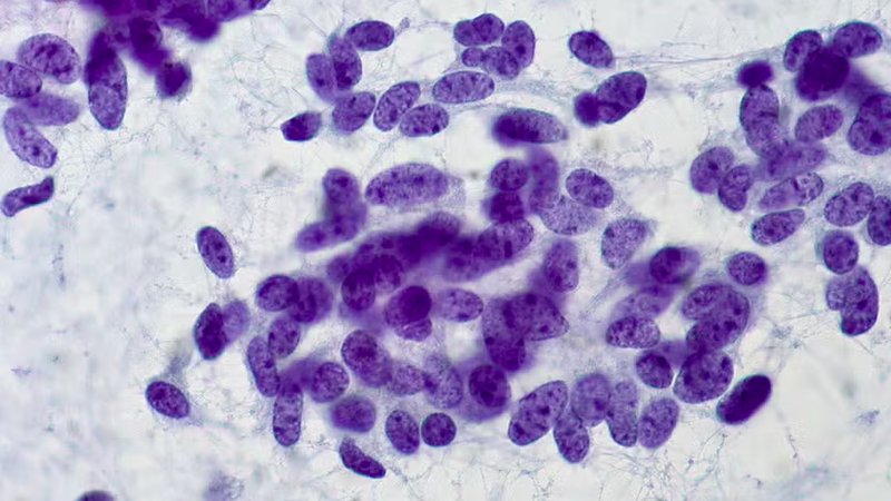 Células cancerígenas: como desenvolvem resistência à quimioterapia