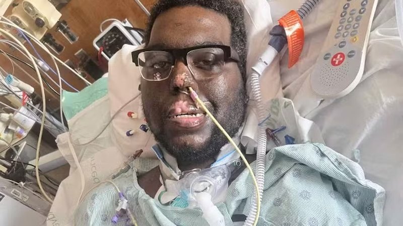 Infecção grave após consulta odontológica leva homem a amputações