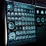 Intervenções Duradouras: Chave para um Cérebro Saudável ao Envelhecer