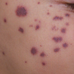 Meningite: 9 Mitos e Verdades sobre Rigidez no Pescoço