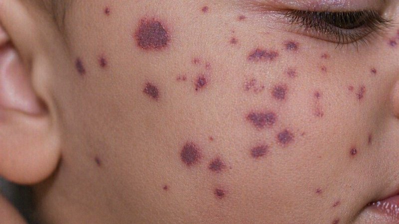 Meningite: 9 Mitos e Verdades sobre Rigidez no Pescoço