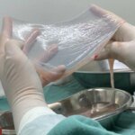 SUS expande tratamento com tecido amniótico para diabetes