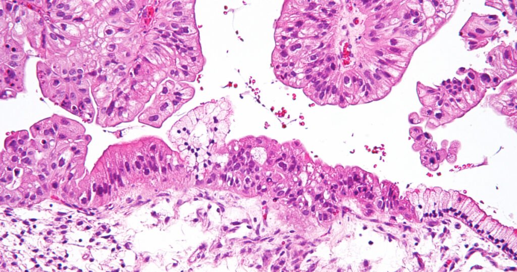 Micrografia em ampliação de um tumor ovariano de baixo potencial maligno em cor de rosa no fundo branco