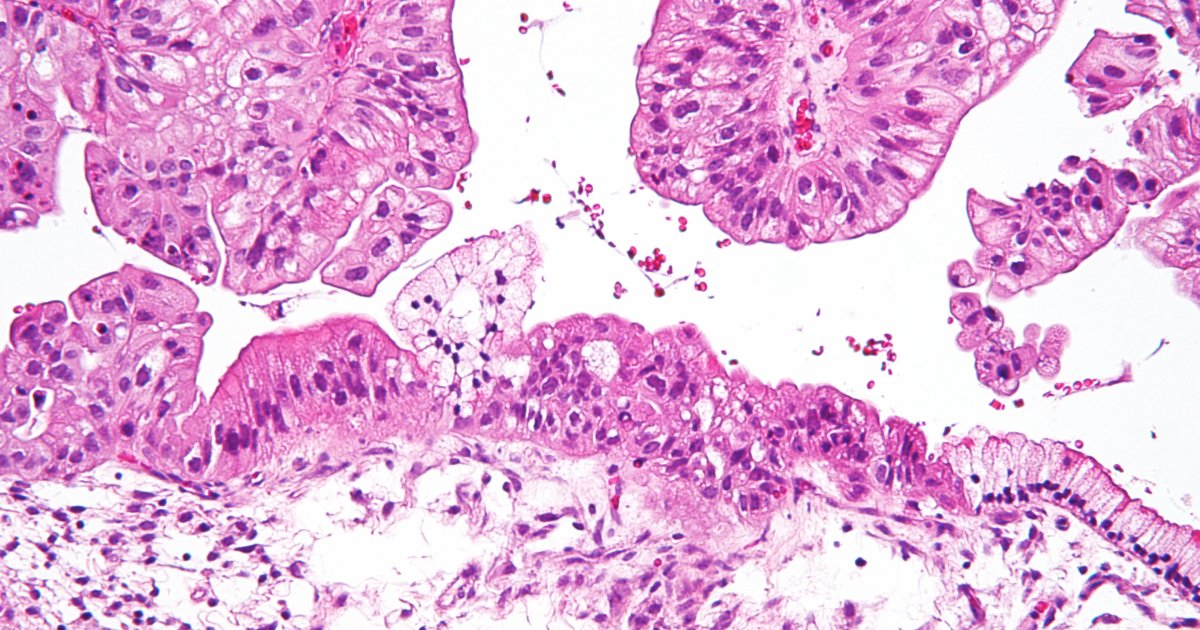 Micrografia em ampliação de um tumor ovariano de baixo potencial maligno em cor de rosa no fundo branco