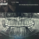 Paciente descobre agulha na boca após cirurgia dental no RJ