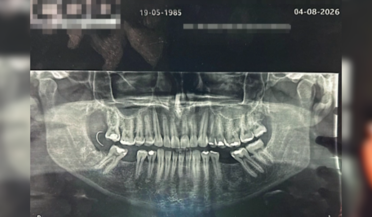 Paciente encontra agulha na boca 10 dias após extração de dente no RJ