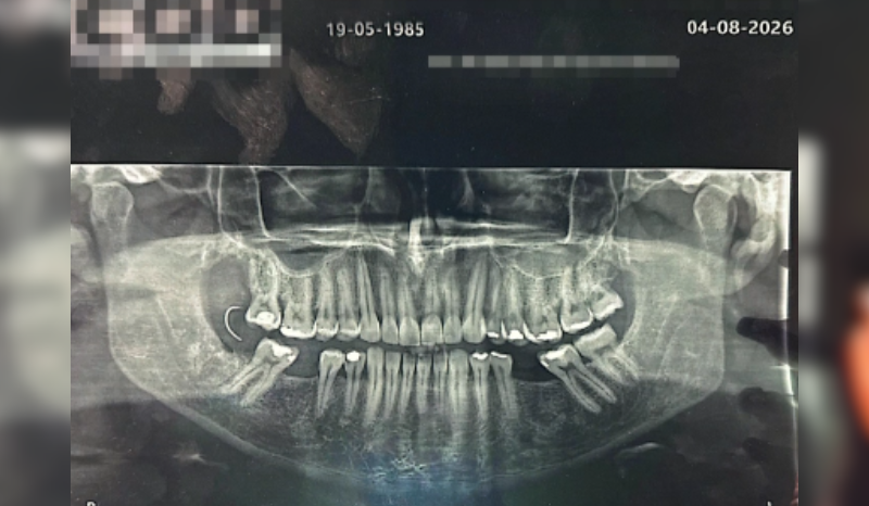 Paciente encontra agulha na boca 10 dias após extração de dente no RJ