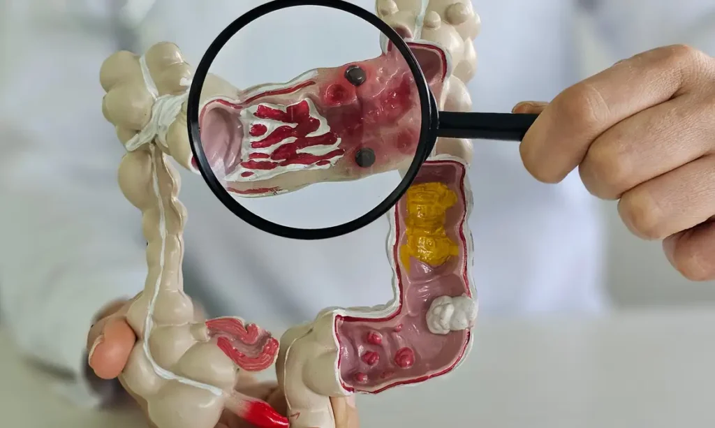 Doença Inflamatória Intestinal no Brasil: Aumento de 500% em 13 Anos