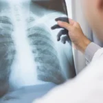 Anvisa libera novo tratamento inovador para câncer de pulmão