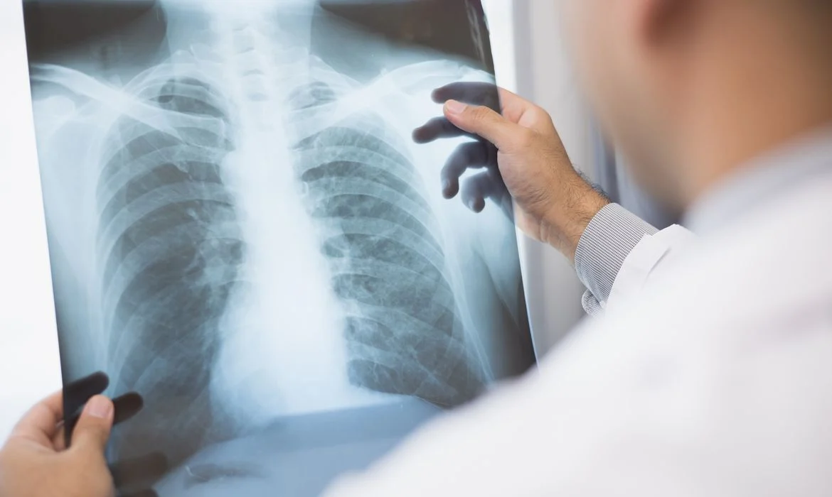 Anvisa libera novo tratamento inovador para câncer de pulmão